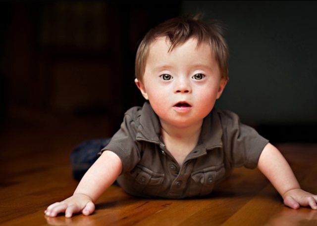 What You Must Know About Down’s Syndrome