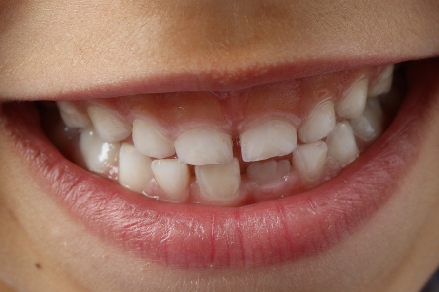 Is Teeth Grinding Harmful For Children?