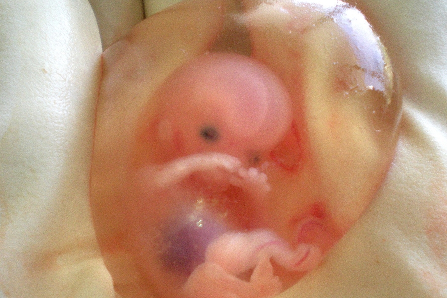 Consequences Of Meconium Aspiration In Womb