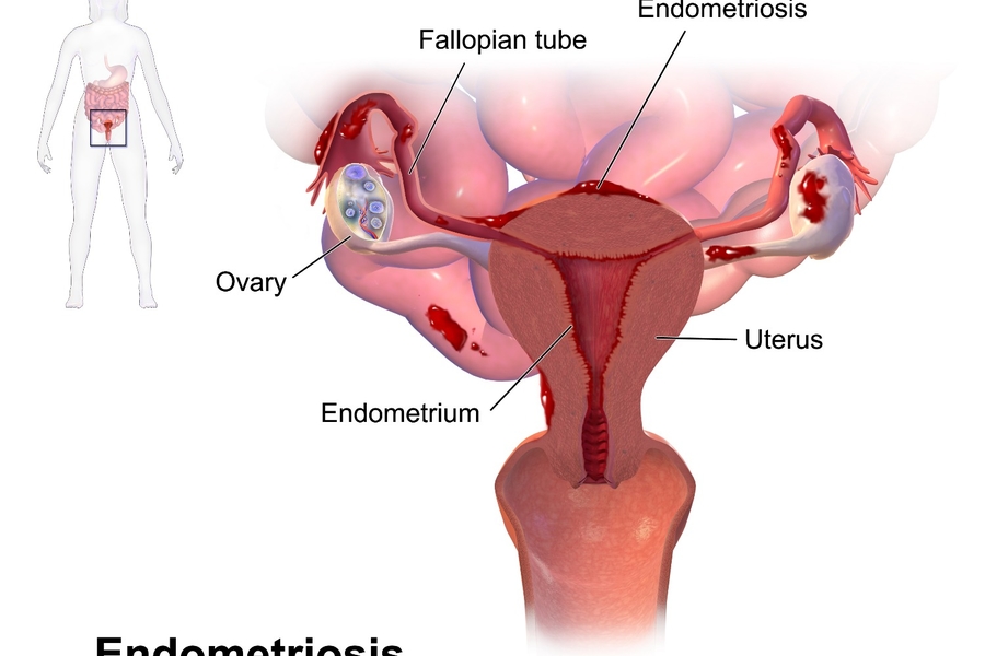 Is Endometriosis Painful