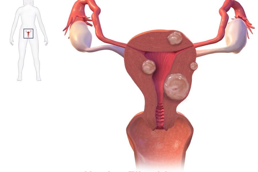 Complications With Fibroids To Be Mindful Of During Pregnancy