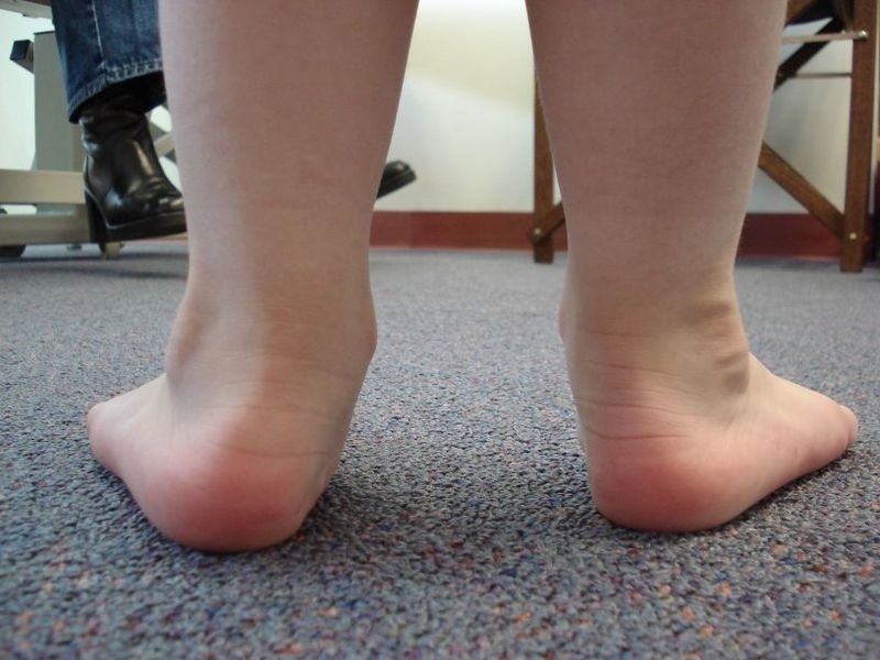 How To Identify Flat Feet In Children?