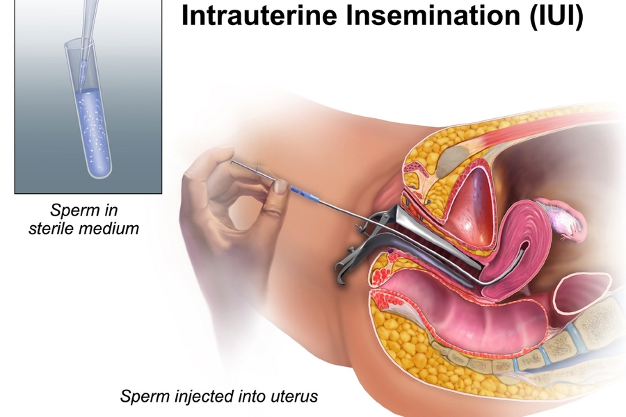 What Happens In An Intrauterine Insemination Procedure?