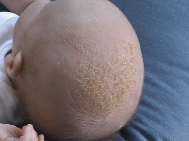Things To Know About Cradle Cap