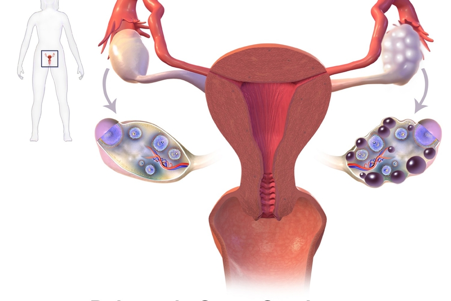 Things To Know About PCOS