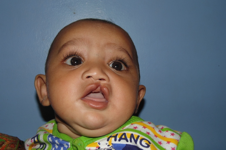 Cleft Lip and Palate &#8211; A Treatable Birth Difference