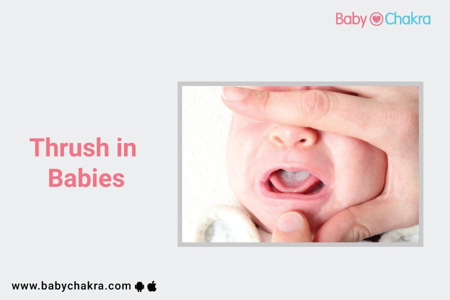Oral Thrush in Babies &#8211; Why Does it Happen?