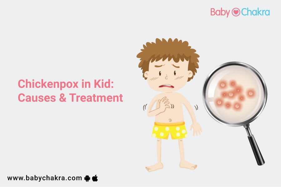 Chickenpox In Kid: Causes &amp; Treatment