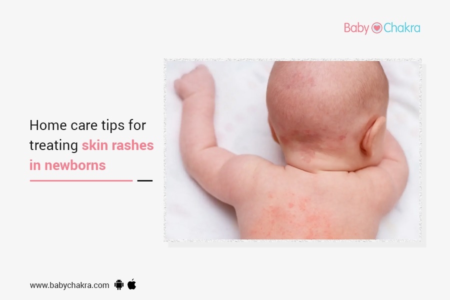 Home Care Tips For Treating Skin Rashes In Newborns