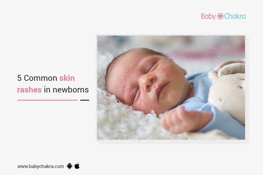5 Common Skin Rashes In Newborns