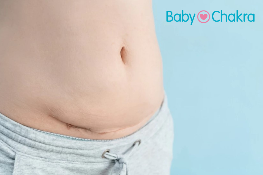 C-section Scars: Types Of Incisions, Healing, And Treatment I BabyChakra