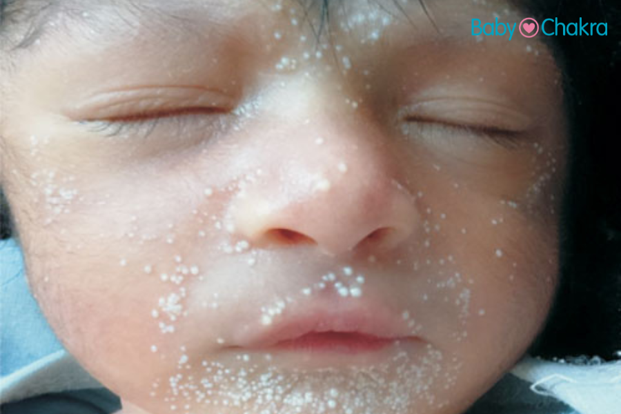 Milia In Newborn Babies: Dr. Soonu Udani Explains The Causes, Symptoms, And Treatment