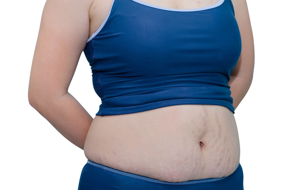 Kalpana Aesthetics - Get rid of Post-pregnancy Bulges, Excess Skin