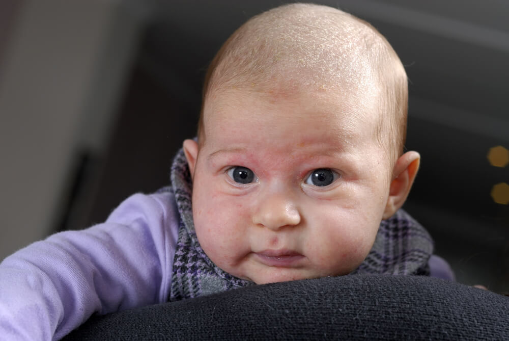 Does Your Baby Have Eczema