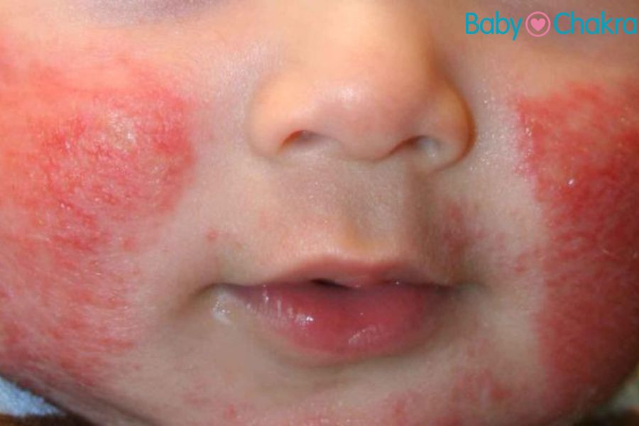शिशुओं में टीथिंग रैश (Teething rash) : कारण, लक्षण, घरेलू उपचार ￼