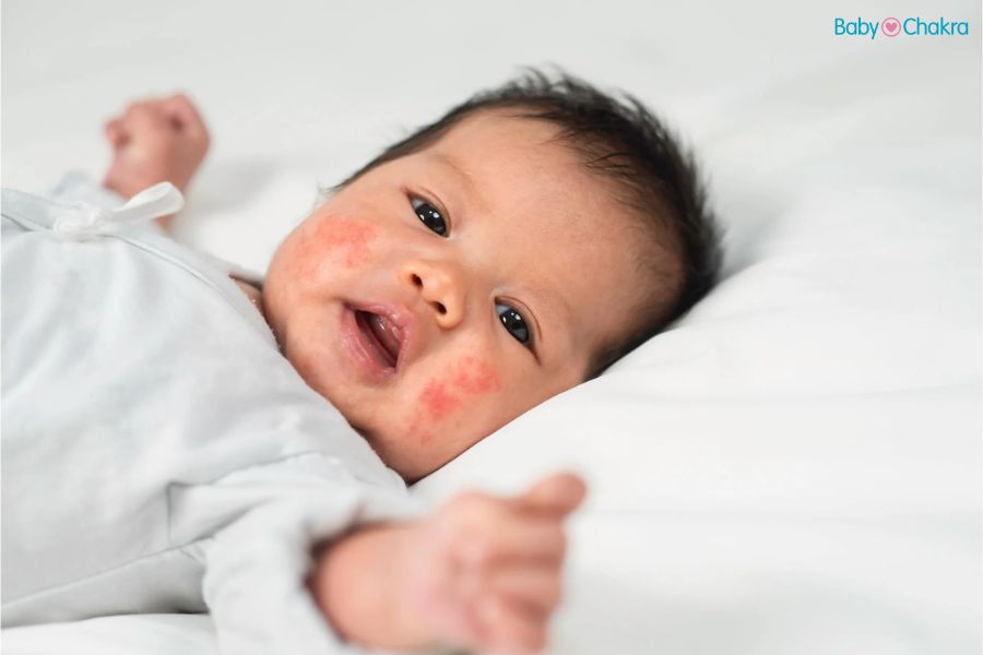 Eczema: शिशुओं में एक्जिमा होने के कारण, लक्षण और घरेलू उपाय