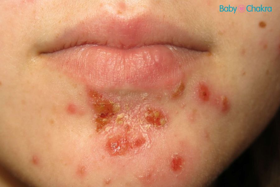 बच्चों में इम्पेटिगो (Impetigo) होने के कारण, लक्षण और बचने के उपाय