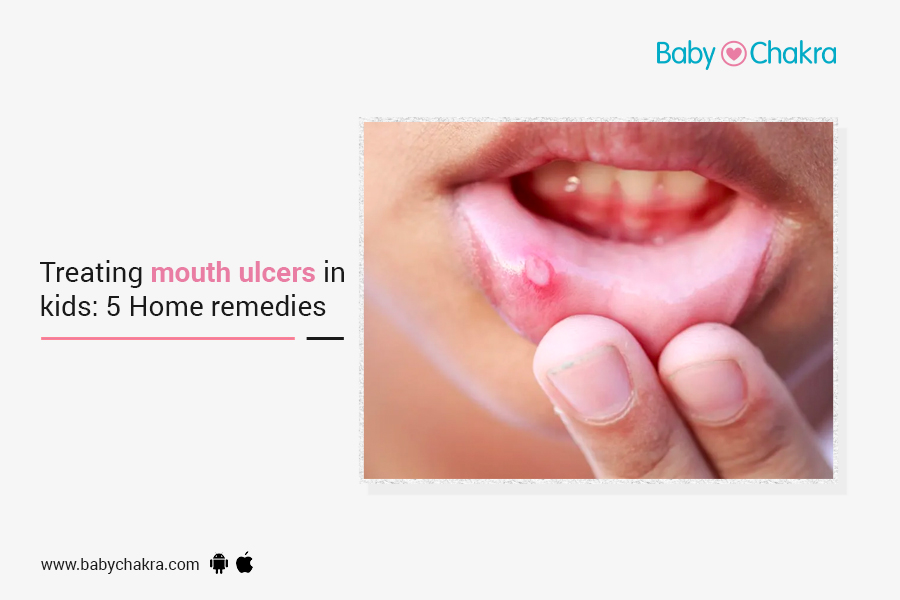 Treating Mouth Ulcers In Toddlers: 5 Home Remedies