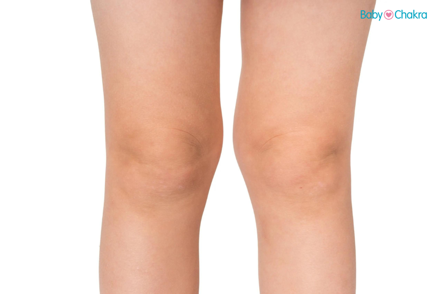 Knock Knees Exercises For Toddlers: Causes And Symptoms