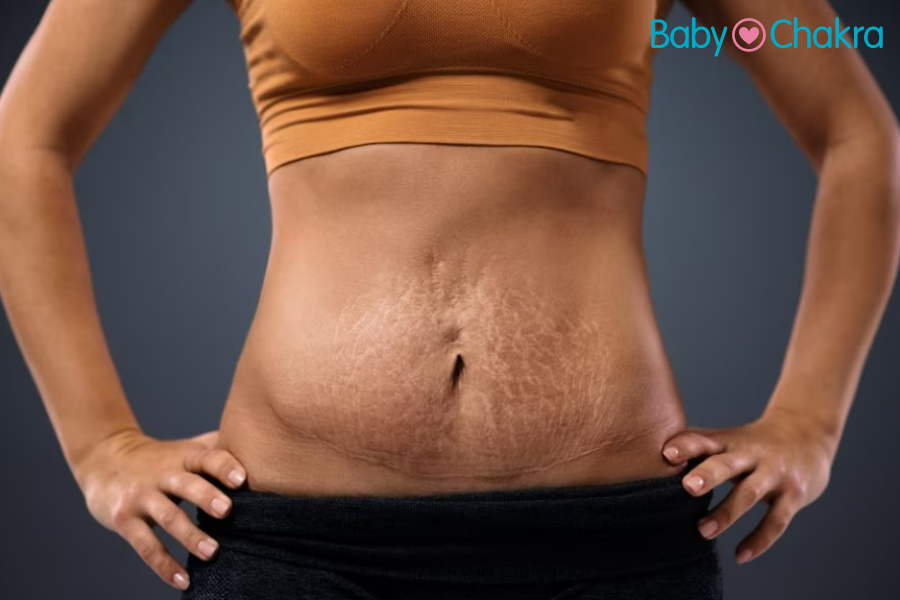 Tighten Belly Skin After Pregnancy: 10 Tips That Actually Work I BabyChakra