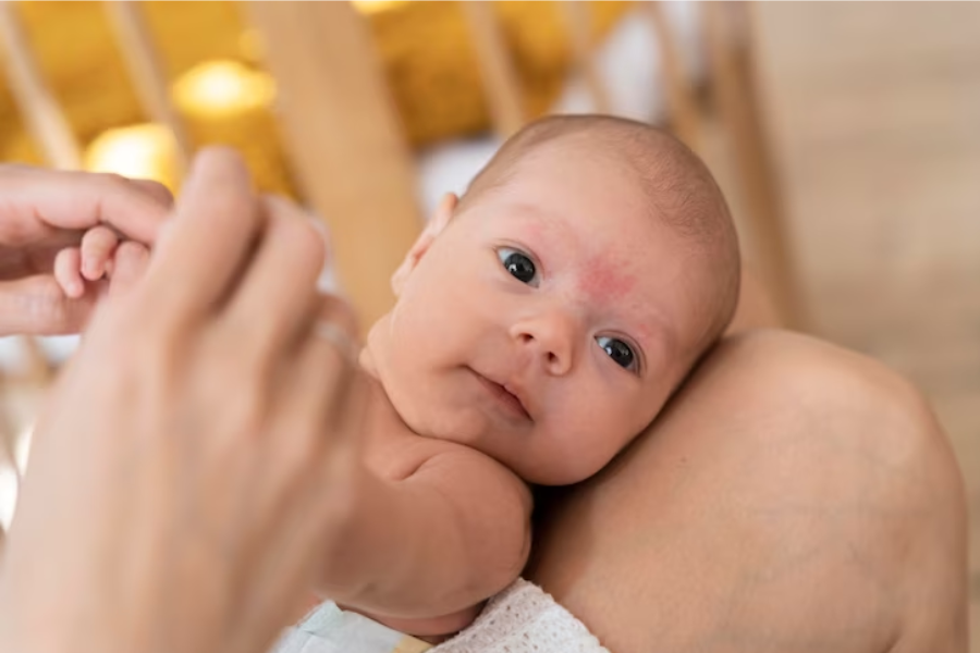 Birthmarks In Newborns: Causes, Types, and Treatment Options