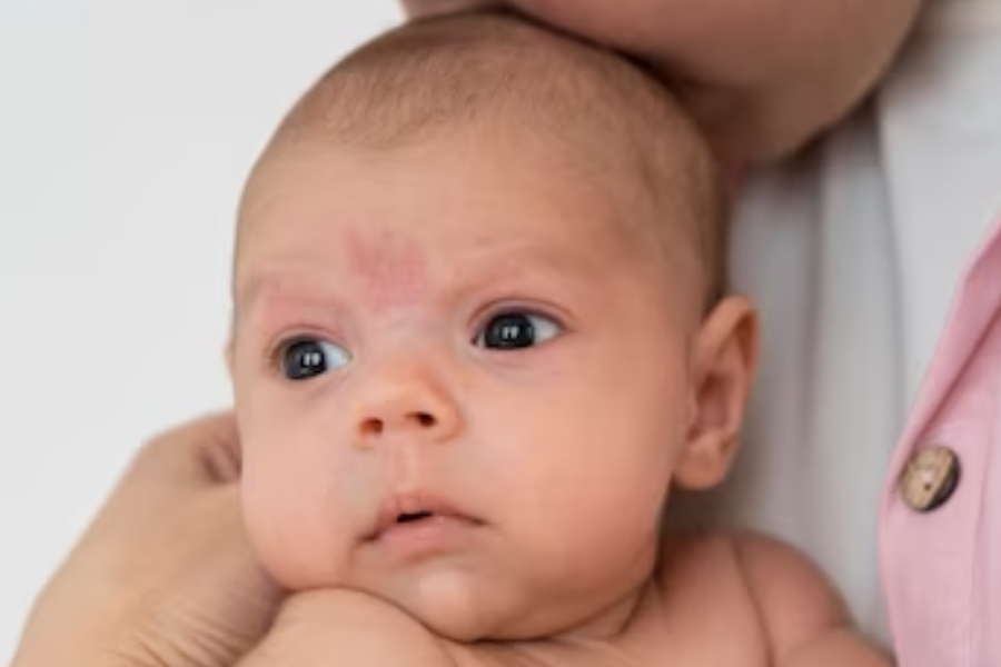 birthmarks in newborns